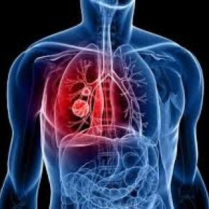 Abcesul pulmonar