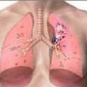 Formele pneumoniei prin hipersenibilizare