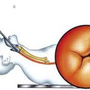 Semiologia esofagului