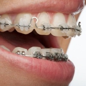 ce este aparatul dentomaxilar