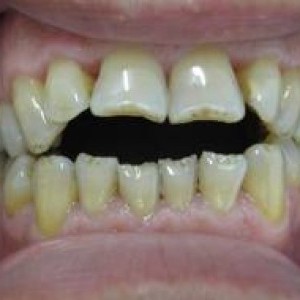 distrofiile dentare