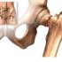 Prevenirea osteoporozei