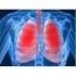 Pneumonia prin hipersensibilizare