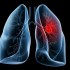 Semnele fizice ale cancerului bronhopulmonar